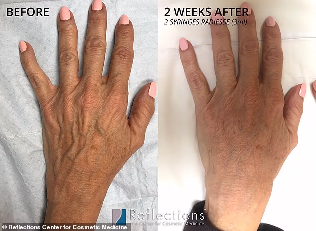 Both men and women with aging, wrinkly hands are attempting to turn back the clock by injecting filler and using other tightening treatments to make their hands smooth once again