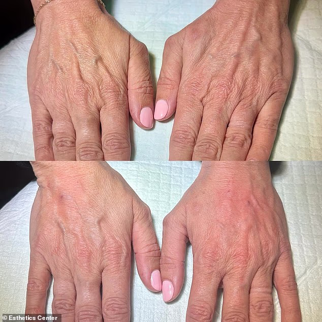 However, he noted that since plastic surgeons are trained in hand surgery and anatomy, they are very comfortable treating the area. Pictured: Before (top) and after (bottom)