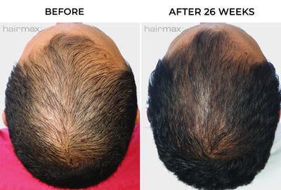 Visible results with consistent use—many users see thicker, fuller-looking hair in as little as 16 weeks.